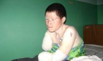 Albinos Under Siege in Tanzania