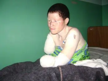 Albinos Under Siege in Tanzania