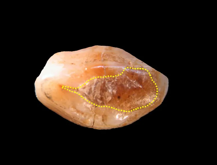 Microphotograph of the tooth crown in occlusal view with indication of the surface covered by beeswax within the dotted line. (Bernardini F, Tuniz C, Coppa A, Mancini L, Dreossi D, et al. (2012) Beeswax as Dental Filling on a Neolithic Human Tooth. PLoS ONE 7(9): e44904. doi:10.1371/journal.pone.0044904)