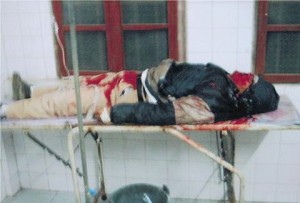 A villager wounded in the shooting in Shanwei, China. (The Epoch Times) A villager wounded in the shooting in Shanwei, China. (The Epoch Times)