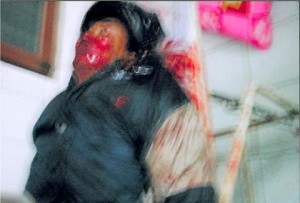A villager wounded in the shooting in Shanwei, China. (The Epoch Times) A villager wounded in the shooting in Shanwei, China. (The Epoch Times)