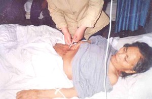 After the operation, Ren's abdominal cavity festered due to the radioactive treatment.