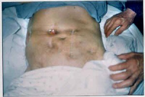 Illegal radiation experiment caused Ren Chuanlan's abdominal area to fester severely.