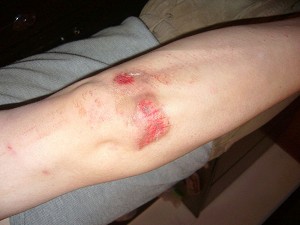 Gao's elbow was injured during the attack. (The Epoch Times) 