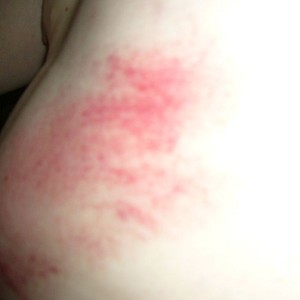 Bruises on Gao's body. (The Epoch Times) 