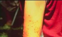 Man Nearly Killed by Fire Ants
