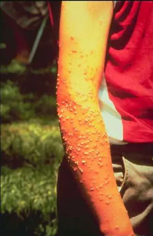 Fire ant stings on aperson's arm (Texas A&M University)
