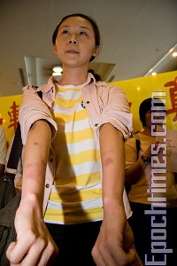 Sound of Hope reporter Ms. Liao Shu-huei, who followed the group to Hong Kong to cover the story, shows bruises she received from the Hong Kong police. (Li Zhuoyu/The Epoch Times) Sound of Hope reporter Ms. Liao Shu-huei, who followed the group to Hong Kong to cover the story, shows bruises she received from the Hong Kong police. (Li Zhuoyu/The Epoch Times)