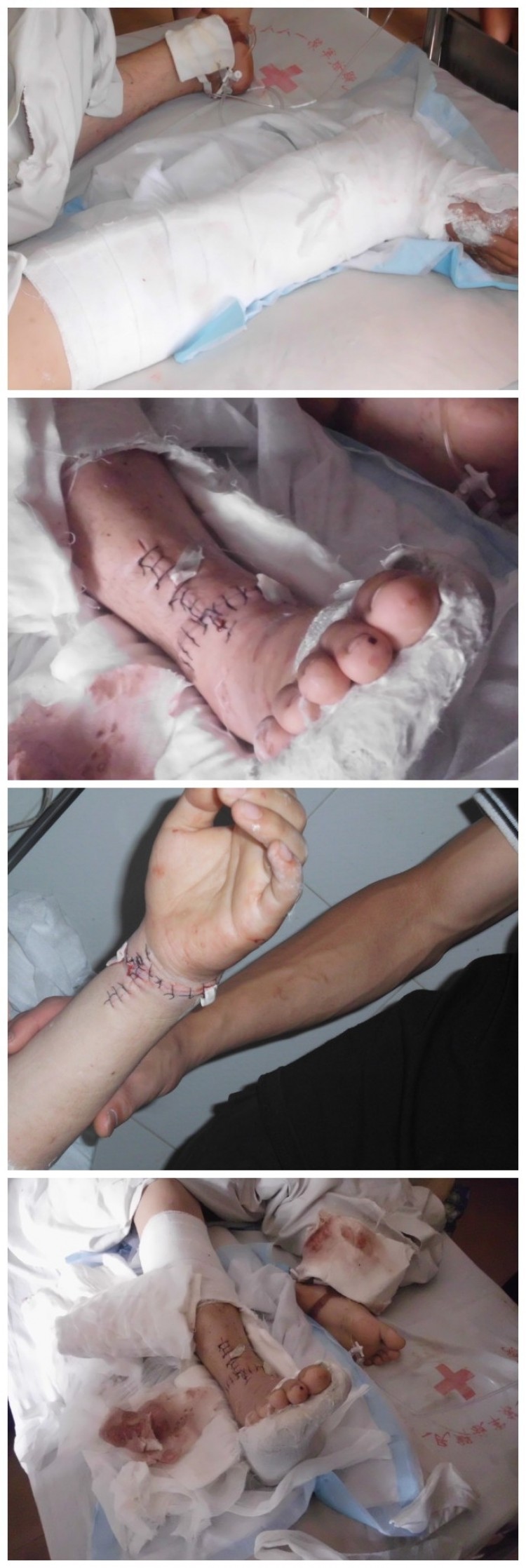 The severe injuries to the tendons of the worker's hands and feet. (Photos posted to BBS) The severe injuries to the tendons of the worker's hands and feet. (Photos posted to BBS)