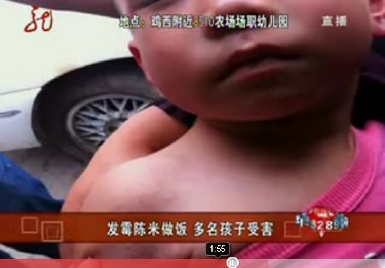 A sick child is rushed to the hospital after eating moldy rice. (Screenshot from Youtube) A sick child is rushed to the hospital after eating moldy rice. (Screenshot from Youtube)