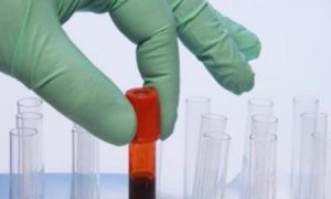 Your Blood Type Might Predict Your Risk of Stroke: New Study