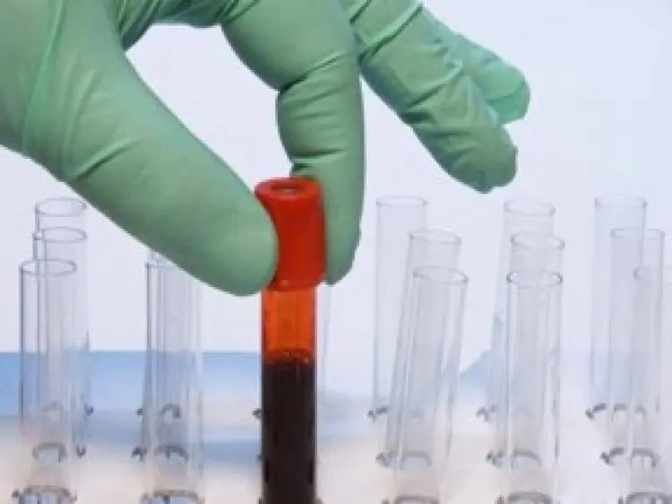 Medical workers who conduct a test to determine a patient's blood type could find the procedure faster and easier in the future using an inexpensive paper-based dipstick test. (iStock)