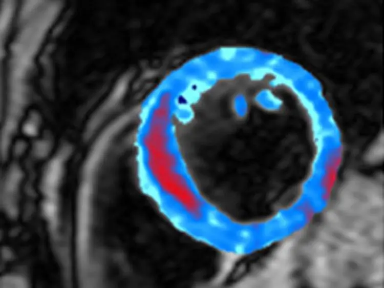 The colored area on this MRI scan shows a cross-section of a heart muscle, with an area of bleeding shown in red. AI and QIS have the potential to revolutionize healthcare and a range of other technologies. (Courtesy of Imperial College London)