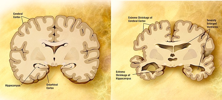 Two diagrams comparing a normal brain (left) with the brain of a person with Alzheimer's disease (right). (Garrondo/Wikimedia Commons) Two diagrams comparing a normal brain (left) with the brain of a person with Alzheimer's disease (right). (Garrondo/Wikimedia Commons)