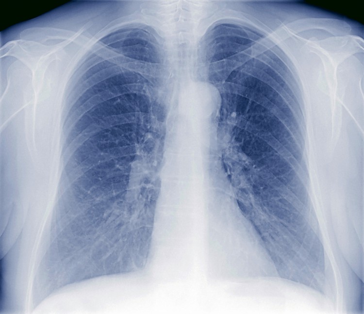 lung disease lung disease