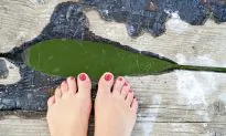 Minimally Invasive Bunion Surgery: No Broken Bones, Quick Recovery