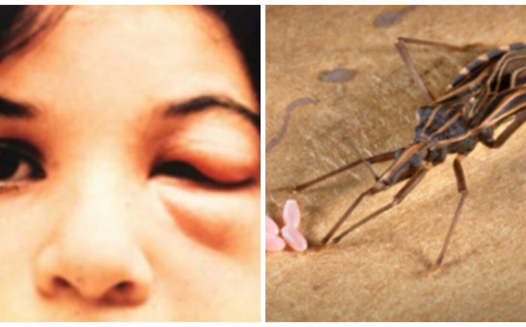 Chagas Disease: Public Warned About Health Risk After a Dozen Get Infected
