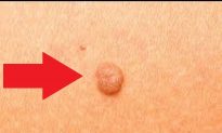 Video: Easy Method Removes Skin Tags Using Ingredient in Your Cupboard