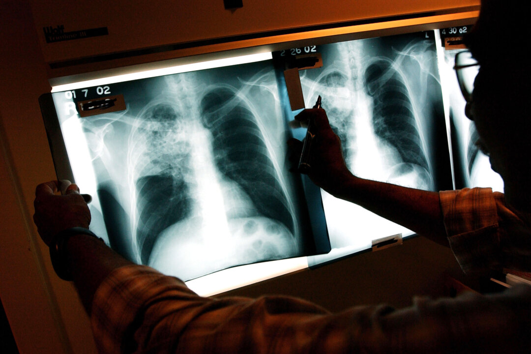 A doctor examines the x-rays of a tuberculosis patient at a TB clinic in Brooklyn, New York, on Nov. 27, 2002. (Spencer Platt/Getty Images)
