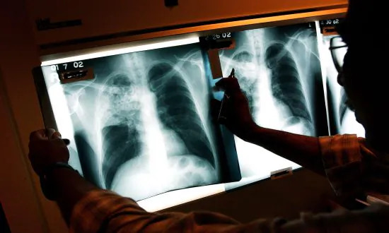 Scientists Develop New Tuberculosis Vaccine