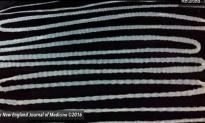 20-Foot-Long Tapeworm Found Inside Chinese Man’s Body (Video)