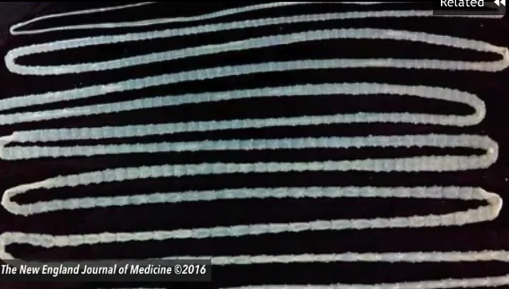 20-Foot-Long Tapeworm Found Inside Chinese Man’s Body (Video)