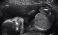 Watch: Unborn Baby Punches Himself in the Face During Ultrasound