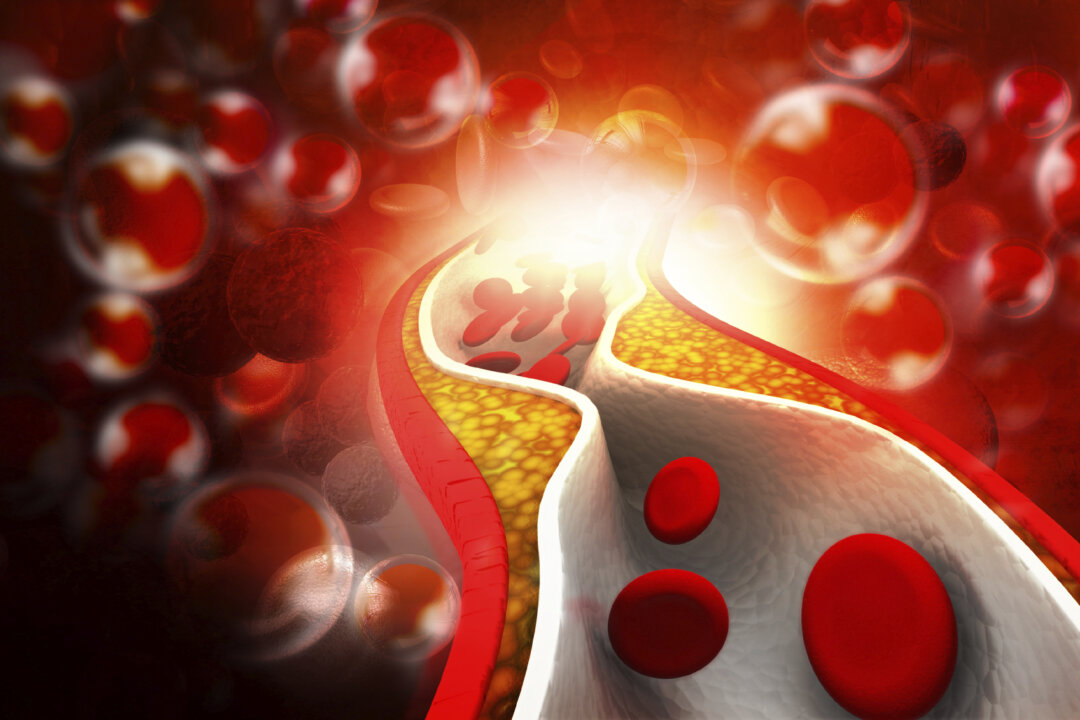 Cholesterol plaque in artery. (HYWARDS/iStock)