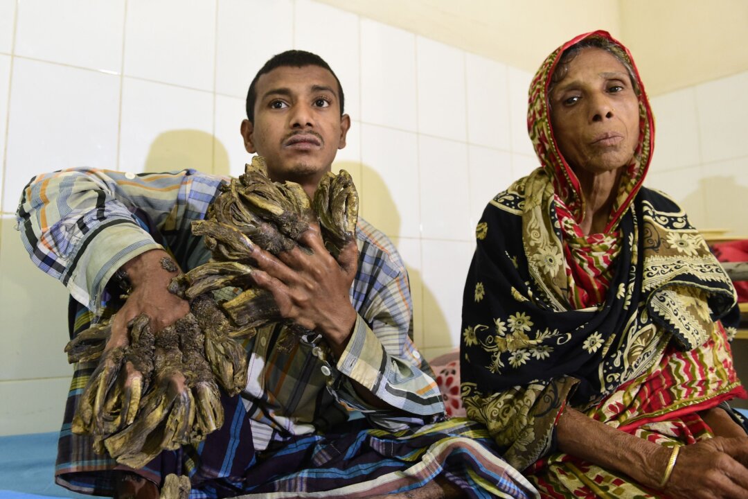 Abul Bajandar (L), 26, dubbed "Tree Man" for massive bark-like warts on his hands and feet, sits at Dhaka Medical College Hospital in Dhaka, on Jan. 31, 2016. (Munir uz Zaman/AFP/Getty Images)