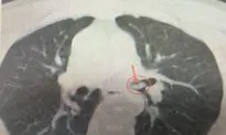 Chinese Doctor Fishes a Shrimp out of a Man’s Windpipe