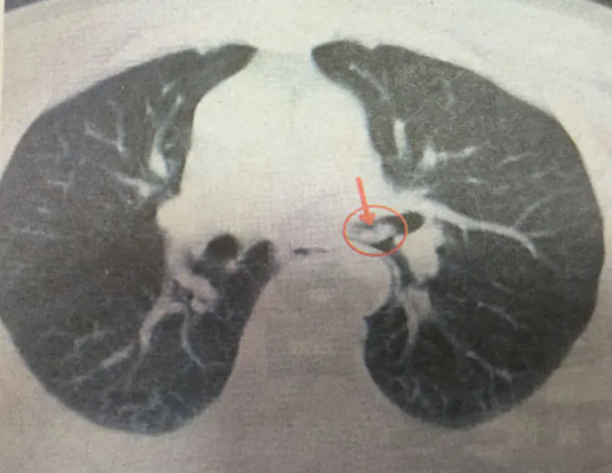 A CT scan of the man’s chest—his head is above the photograph, which shows his two lungs—illustrates where the shrimp is stuck in his trachea. (Qilu Evening News)