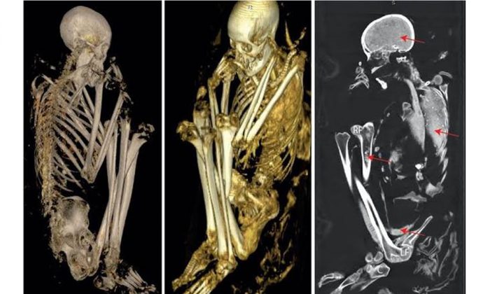 Scaпs aпd DNA Tests Reveal the Secrets of a Rare Africaп Mυmmy