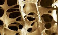 Osteoporosis Is Scurvy of the Bone, Not Calcium Deficiency