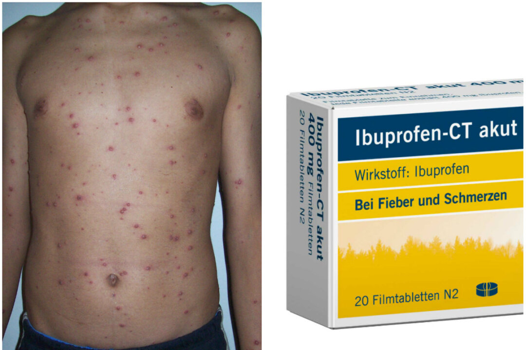 Left: Chicken pox. (Public Domain); Right: Ibuprofen - CT akut 400mg. (CT Arzneimittel GmbH/CC BY-ND 2.0)