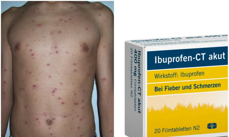 Never Give Ibuprofen or Aspirin to Child With Chicken Pox