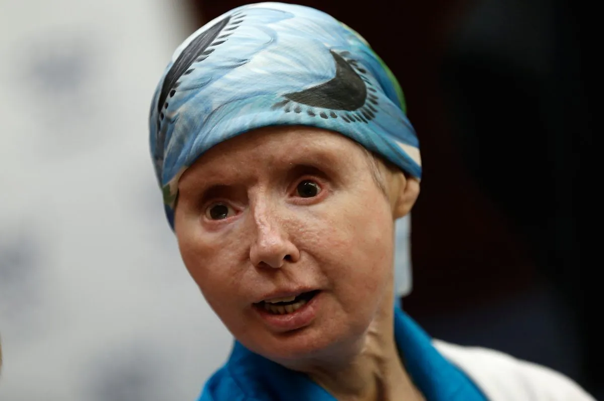 Charla Nash, the victim of a mauling by a pet chimp in Connecticut in 2009 and who underwent a face transplant, speaks at a press conference July 10, 2014 on Capitol Hill in Washington, DC. (Photo by Win McNamee/Getty Images)