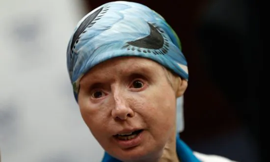 Charla Nash Opens Up Over Recent Facial Transplant Rejection