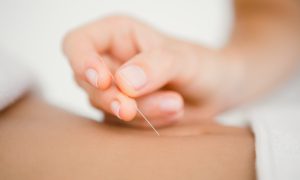 The Difference Between Chinese Medicine, Acupuncture, and Dry Needling