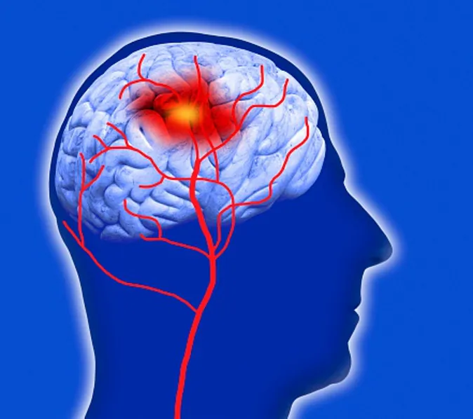 Human brain showing stroke (computer artwork/Getty Images)
