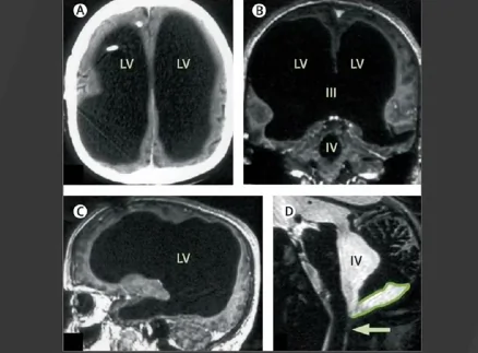 Case of Man Missing 90% of Brain but Functioning Normally Stuns Scientists (Video)