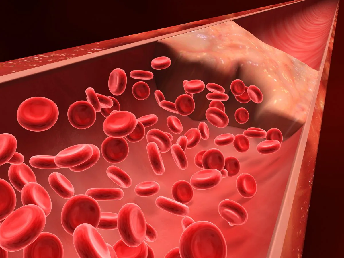 Blood clot, calcified lesion, and plaque in an artery restricting blood flow. (BioMedical/Shutterstock)
