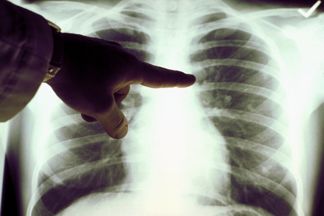 A view of a close up of a lung x-ray of a cigarette smoker in an undated photo. (Photo Courtesy of the American Cancer Society via Getty Images)