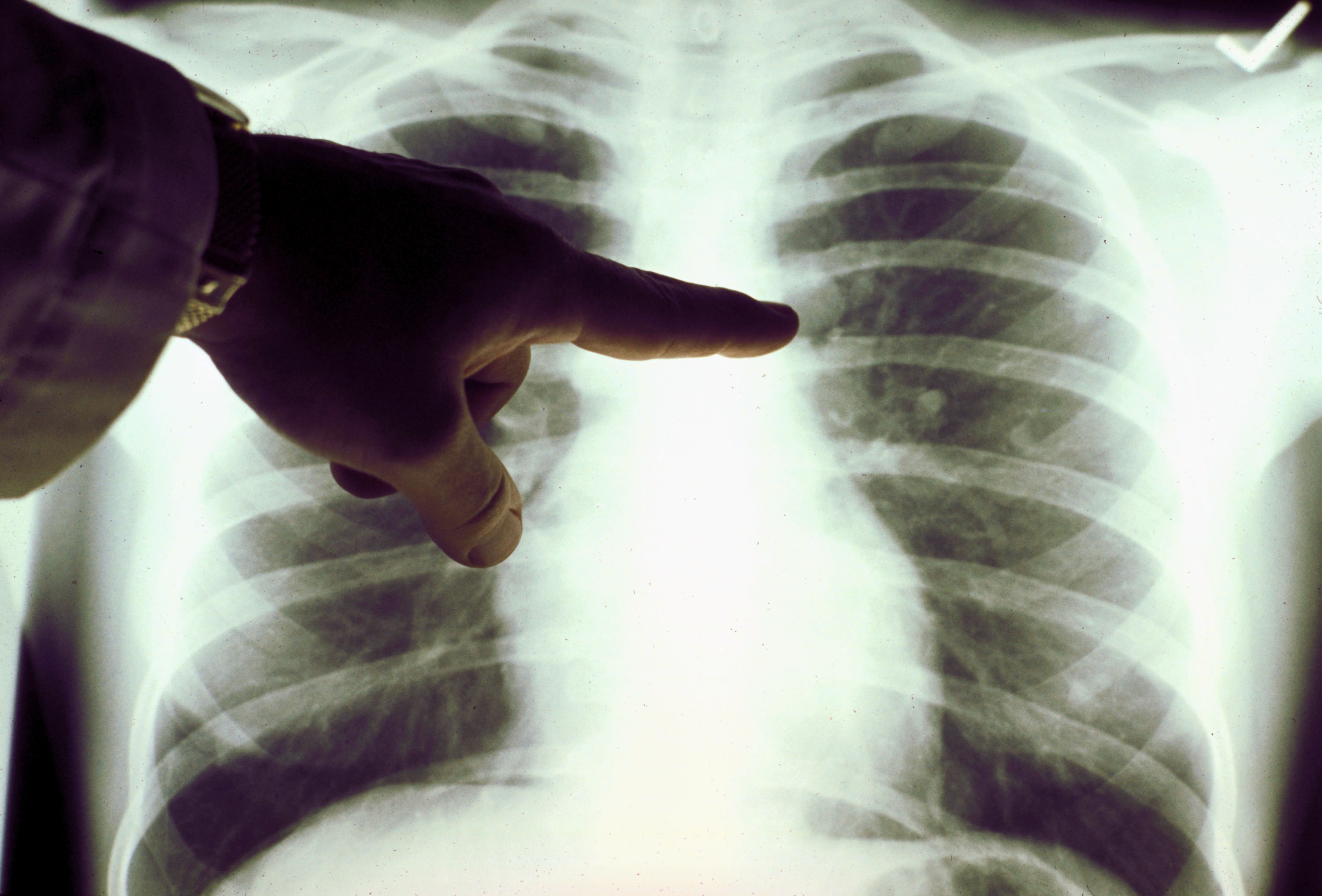 Your Lung Function Is an Important Predictor of Health and Longevity - Vimarsana News