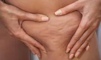 3 Evidence-Based Ways to Reduce Cellulite