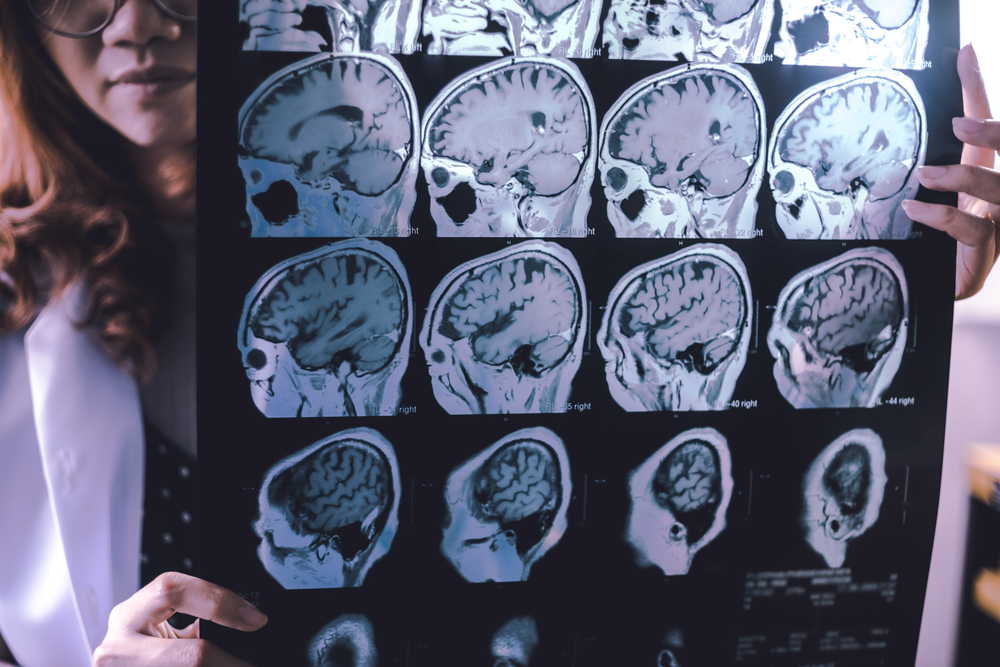 frontal lobe atrophy on MRI film probably Frontotemporal Dementia. (Atthapon Raksthaput)