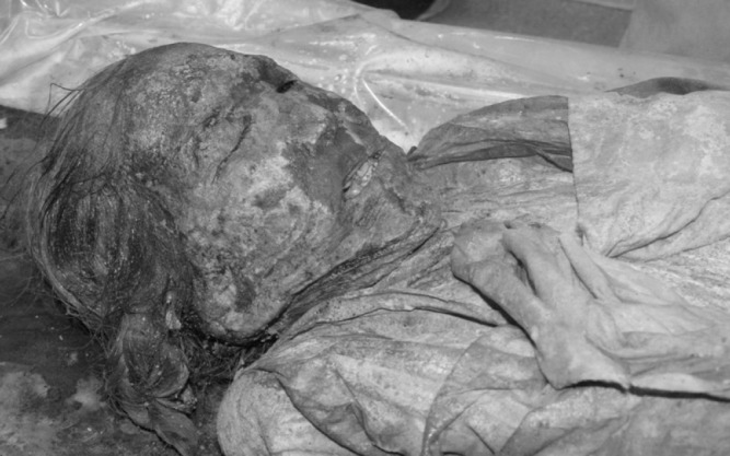 A female Korean mummy (ncbi.nlm.nih.gov)