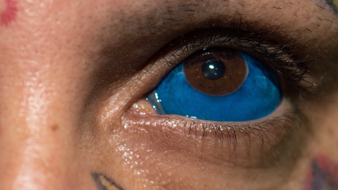 Young Model Could Lose Vision After Botched Eyeball Tattoo