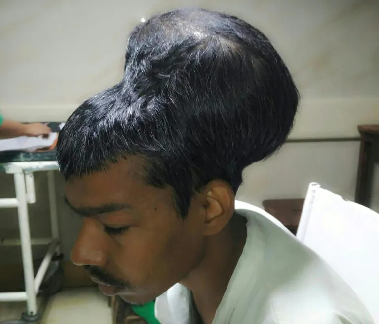 Santlal Pal before undergoing surgery to remove a brain tumour weighing nearly two kilos at Nair hospital in Mumbai Department of Neurosurgery Topiwala National Medical College, Nair Hospital/AFP /