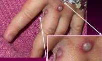 Second Case of Rare Monkeypox Surfaces in the UK