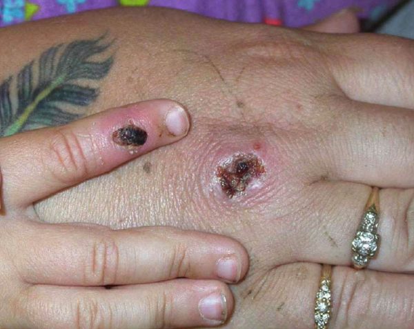 Monkeypox lesions shown on a patient's hand